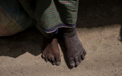 This was the time I began to understand the devastation and heartbreak created by lymphatic filariasis (LF)