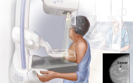 The Nyeri County Government, Ministry of Health’s National Cancer Control Program (NCCP) and GE Healthcare have launched a Mammography screening campaign across Nyeri County to promote early detection of breast cancer.