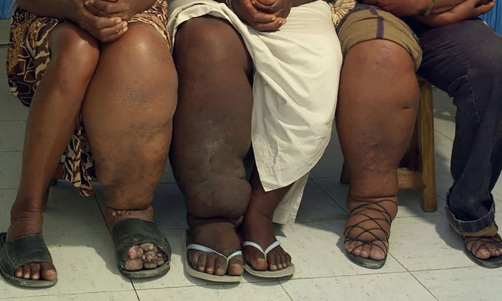 Drive to Eliminate Elephantiasis in East Africa